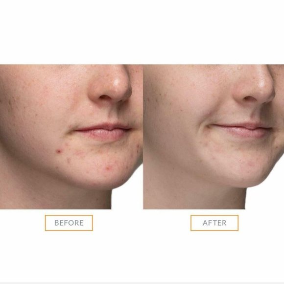 Clarisonic Acne Cleansing Brush Head (2nd Generation) - NEW FACTORY SEALED - Picture 6 of 13